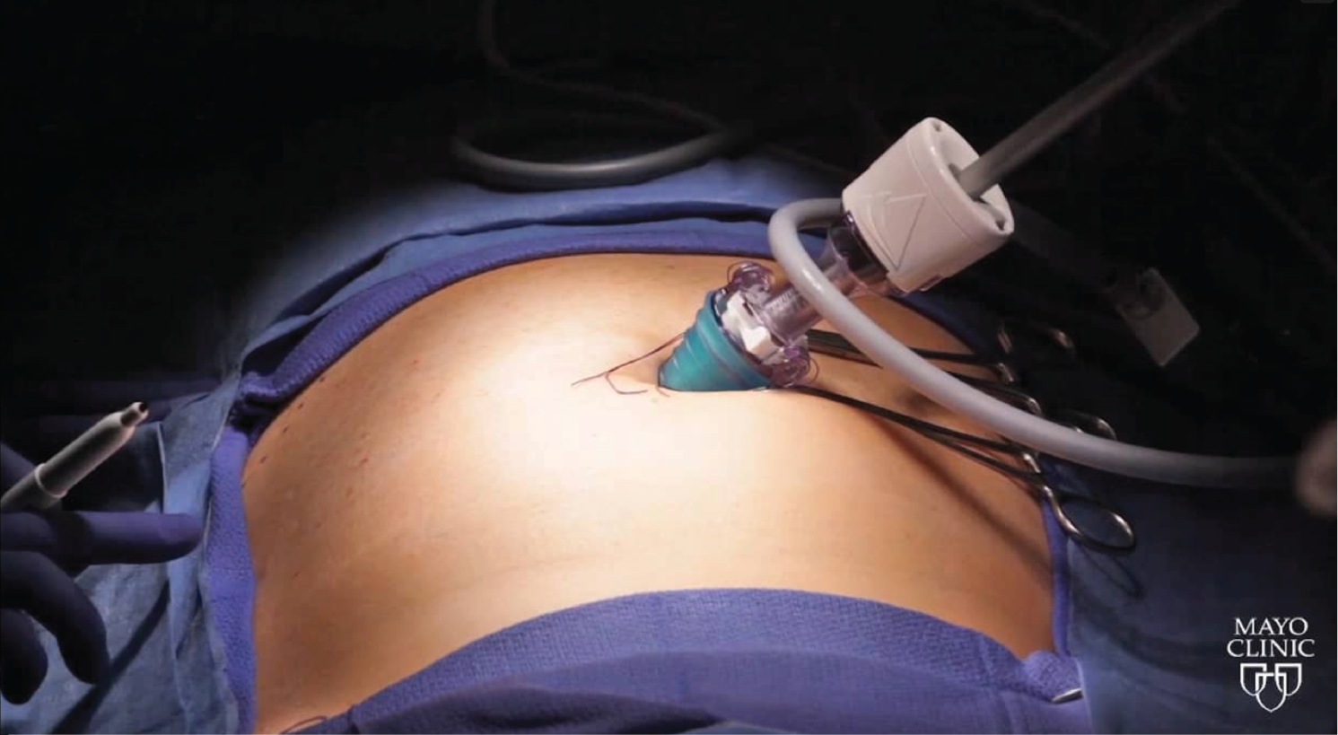 LAP Guided TAP Block