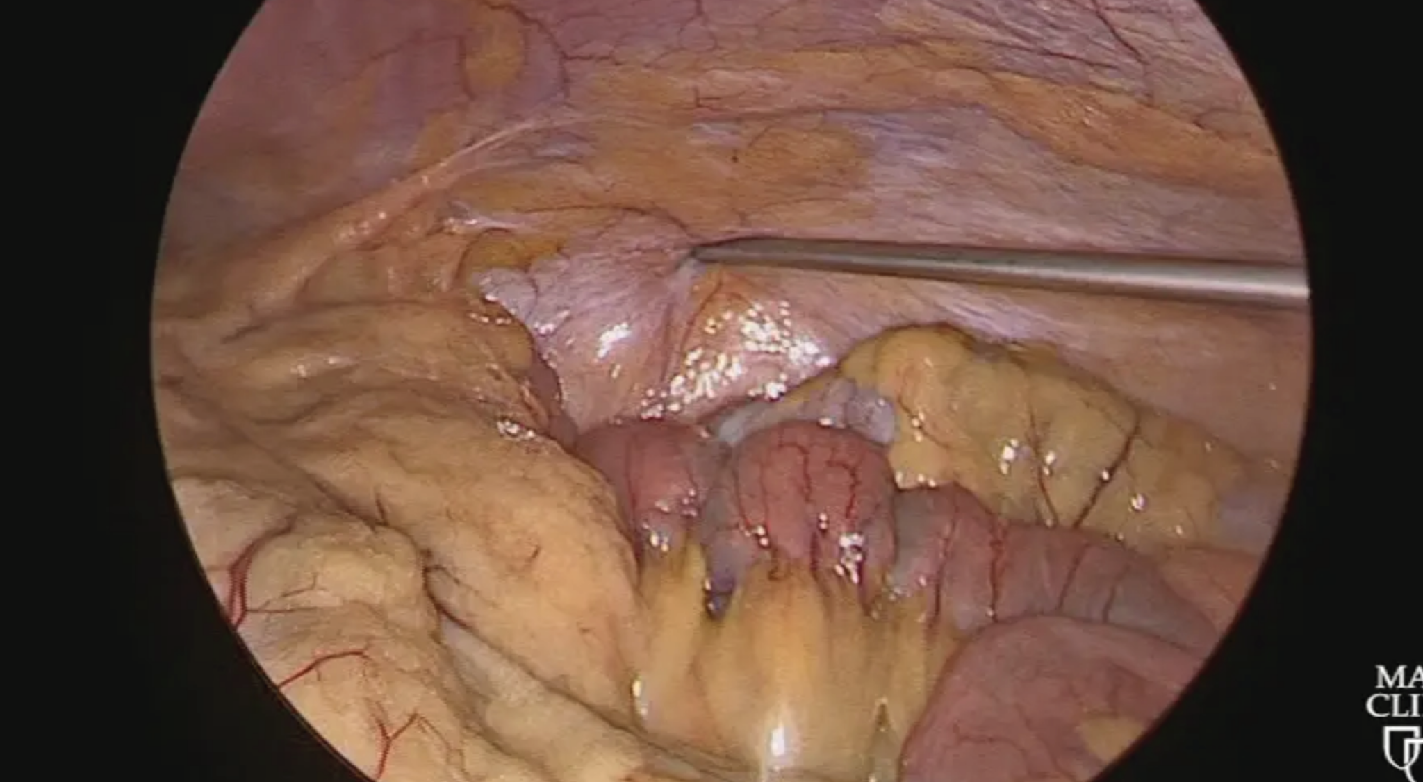How to Transversalis Fascia Block 1 T Young Fadok