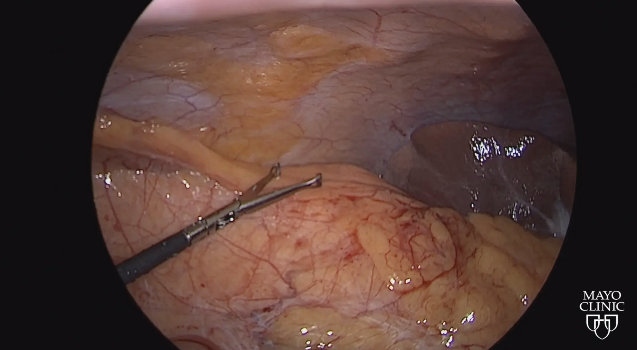 How to Transversalis Fascia Block 2 T Young Fadok