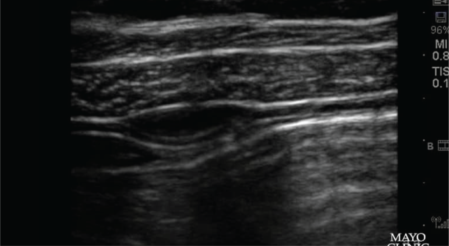 US TAP Video Injecting