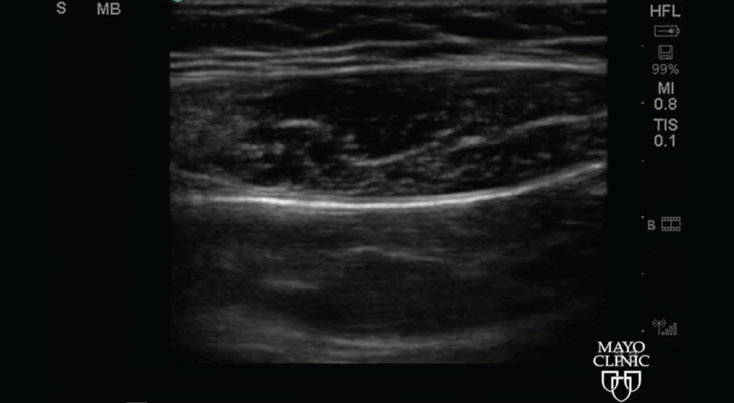 How To US View Rectus Muscle